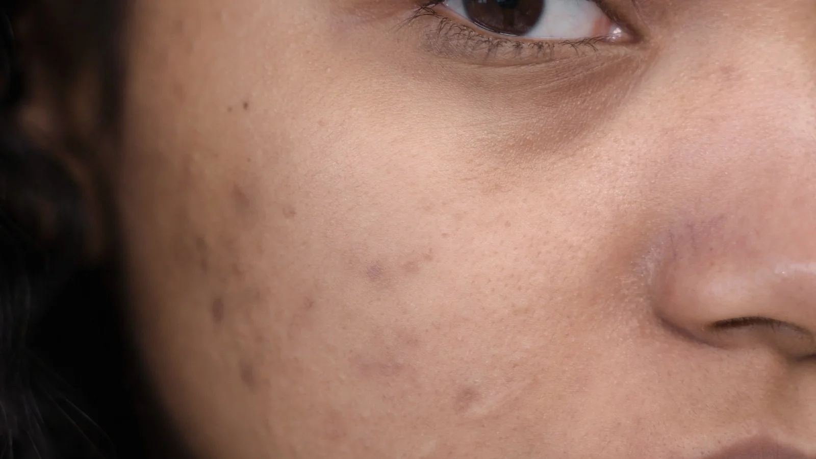 Acne e cicatrizes, cicatrizes de acne, imagem editorial de blog com Franciele Sofiati em Londrina na blog, imagem 5